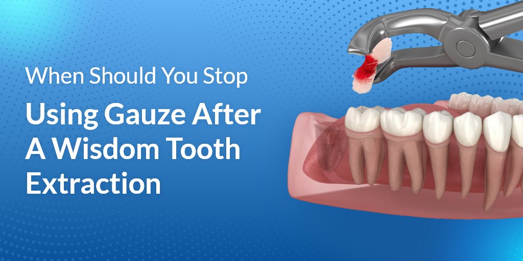 When To Stop Using Gauze After Tooth Extraction: Expert Advice